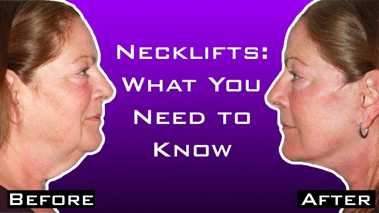 An Introduction to Facelifts and Neck Lifts