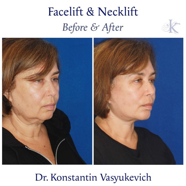 Facial Plastic Surgery in Manhattan, NYC | Dr. Konstantin Vasyukevich